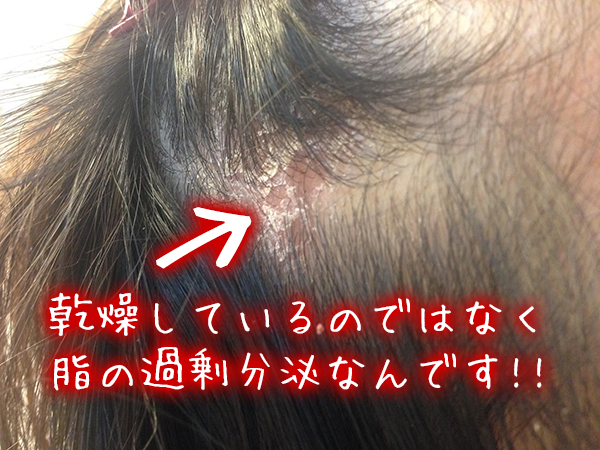 脂漏性皮膚炎の原因は頭皮の乾燥ではなく、脂の過剰分泌.jpg