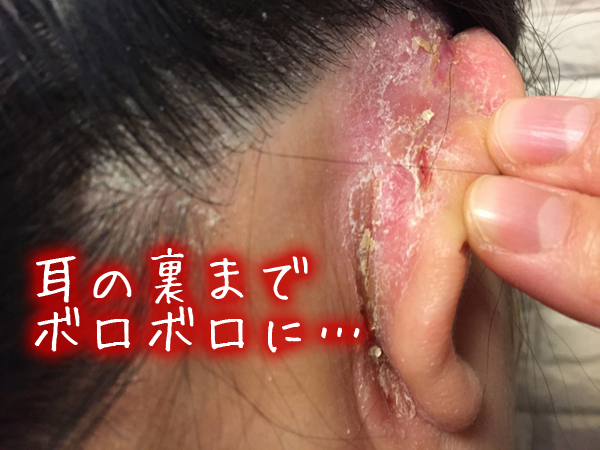 脂漏性皮膚炎・耳の裏の湿疹・かゆいボロボロ.jpg