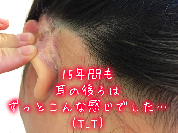 頭皮湿疹で耳の裏の炎症.jpg
