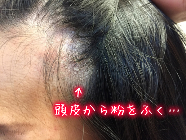 頭皮湿疹で頭皮から粉をふく.jpg